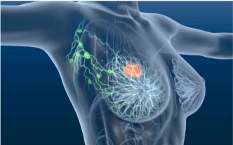 Tunisie : entre 800 et 1 500 nouveaux cas de cancer du sein chaque année