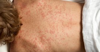 Santé. Hausse spectaculaire des cas de rougeole : êtes-vous correctement vacciné ?