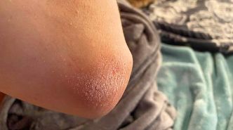 Si vos Coudes sont Secs, Voici ce que votre Corps Essaie de Vous Dire (et vous Devriez y Prêter Attention).