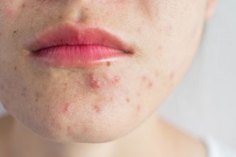 Papules : faut-il les percer, les ignorer ou les traiter ?