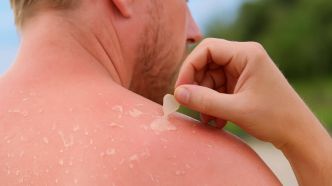 Peau qui pèle après un coup de soleil ? Voici les bons gestes à adopter
