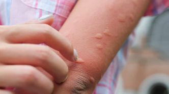 Ces astuces magiques pour calmer les piqûres de moustiques et les démangeaisons