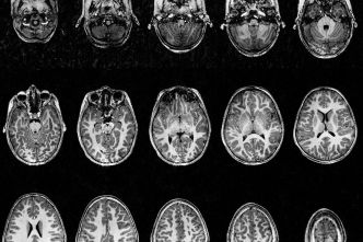 Cerveau de l'enfant : une nouvelle technique d'IRM permet d'obtenir des images d'une précision inédite