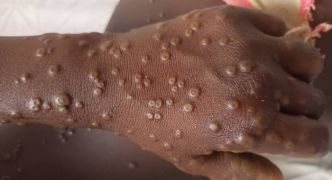 Mpox en Guinée : l'État sonne l'alerte, la riposte s'organise