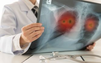 Le cancer du poumon touche aussi les non-fumeurs, quelle en est la cause ?