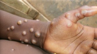 Guinée/Mpox : l’épidémie en nette progression