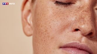 Taches de rousseur : pourquoi sont-elles plus présentes sur la peau en été ?  | TF1 INFO