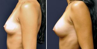 Lipofilling mammaire Tunisie : Chirurgie esthetique seins