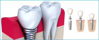 implant dentaire en Tunisie : Combien coûte ?