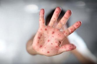Nouvelle épidémie de monkeypox : que sait-on de ce virus ?