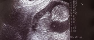 L'Organisation mondiale de la santé dit craindre que la décision de la Cour suprême américaine d'enterrer le droit à l'avortement risque d'avoir des effets préjudiciables bien au-delà des [...]