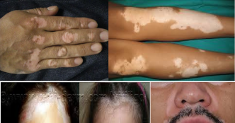 Le vitiligo, quelques remèdes