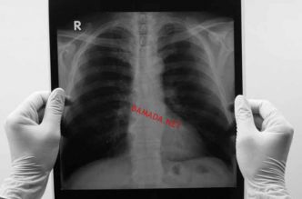 Tuberculose : la maladie gagne du terrain